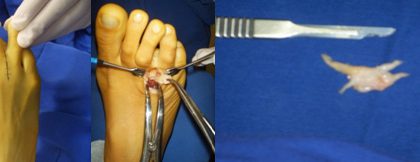 Cirurgia reconstrutiva de pé e tornozelo em Joinville, Blumenau, Camboriú, Florianópolis e Chapecó