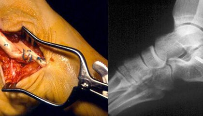 Cirurgia reconstrutiva de pé e tornozelo em Joinville, Blumenau, Camboriú, Florianópolis e Chapecó