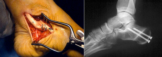 Cirurgia reconstrutiva de pé e tornozelo em Joinville, Blumenau, Camboriú, Florianópolis e Chapecó