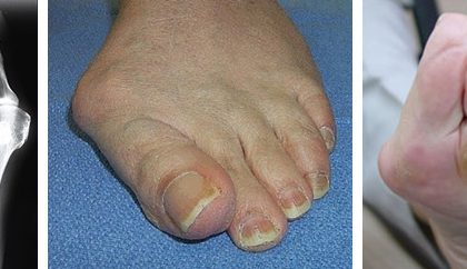 Cirurgia reconstrutiva de pé e tornozelo em Joinville, Blumenau, Camboriú, Florianópolis e Chapecó
