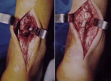 Cirurgia reconstrutiva de pé e tornozelo em Joinville, Blumenau, Camboriú, Florianópolis e Chapecó