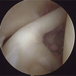 Artroscopia do Joelho