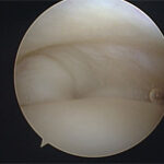 Artroscopia do Joelho