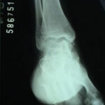 Artrose do Tornozelo 2