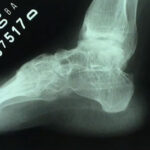 Artrose do Tornozelo 4