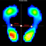 Avaliação Baropodométrica Estática