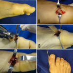 Cirurgia Reconstrutiva do tornozelo e pé