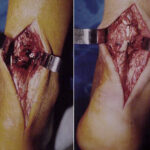 Cirurgia Reconstrutiva do tornozelo e pé 7