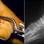 Cirurgia Reconstrutiva do tornozelo e pé 8