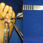 Cirurgia Reconstrutiva do tornozelo e pé 9