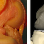 Lesão de Ligamento Cruzado