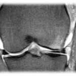 Lesão de Ligamento Cruzado 2