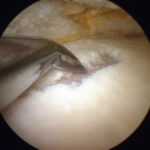 Artroscopia do Joelho