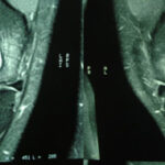 Artroscopia do Joelho