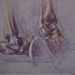 Traumatologia Esportiva