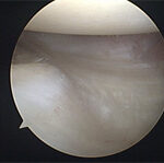 Artroscopia do Joelho