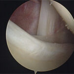 labrum posterior