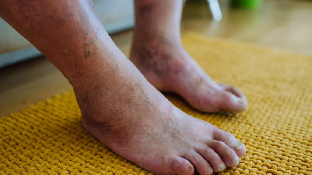 Dr. João Luiz Vieira da Silva: ortopedista especialista em Pé Diabético. Prevenção e tratamento em Curitiba, PR e SC.