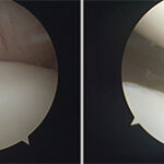 Artroscopia do Joelho